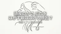 頭皮のかさぶたをはがす癖ははげる原因？