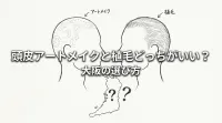 頭皮アートメイクと植毛どっちがいい？大阪の選び方