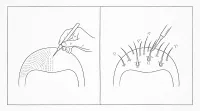 頭皮アートメイクと植毛どっち？原理から違いを解説