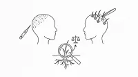 頭皮アートメイクと植毛、どっちを10代で選ぶべき？