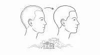 生まれつきおでこが広い、植毛で改善できる？大阪でのクリニック選びのポイント