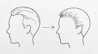 生まれつきおでこが広い人に植毛は効果的？