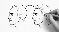 生まれつきおでこ広い男性は植毛で改善できる？